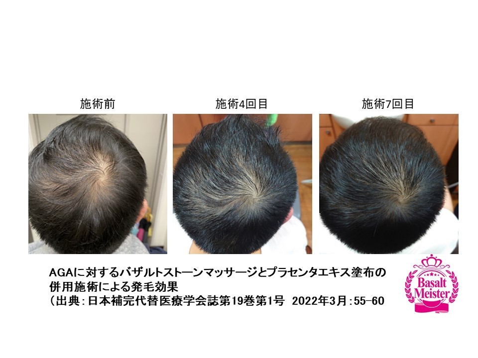 育毛ケアオプション イメージ1